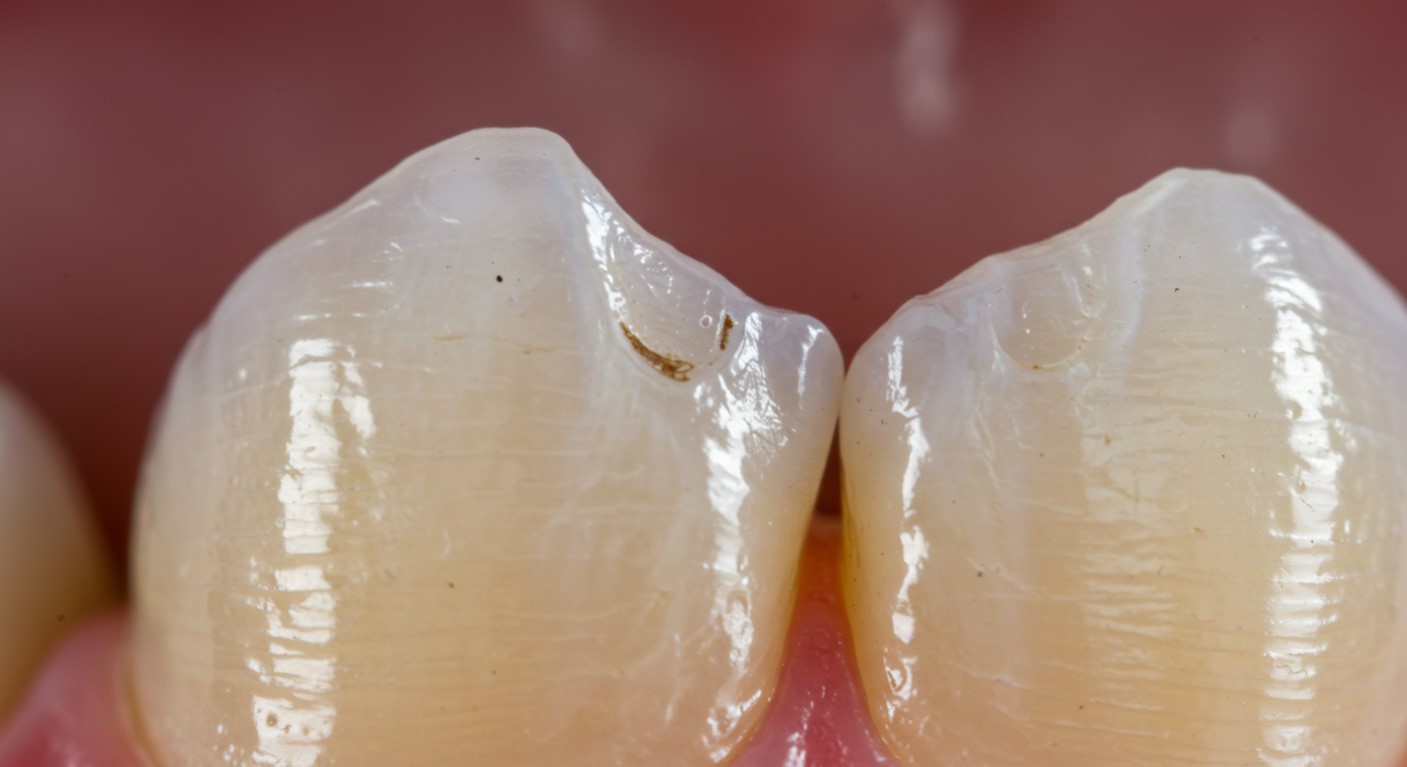 Composite Bonding for A Chipped Tooth
