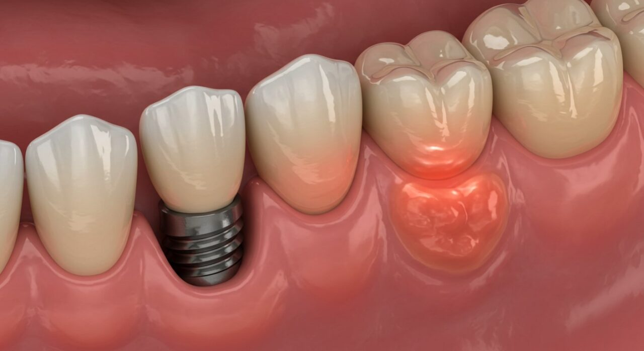 Potential Risks and Complications